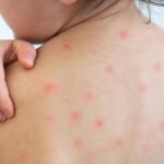 হাম কীভাবে ছড়ায়? হলে যা করবেন